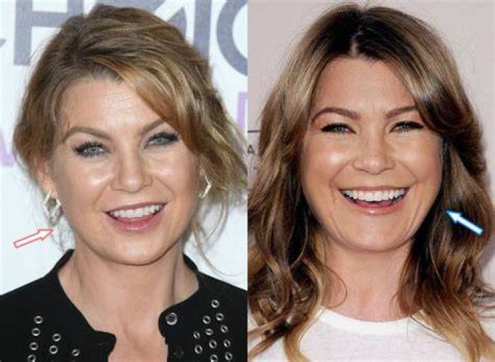 Ellen Pompeo Plastic Surgery Before and After Botox Injections