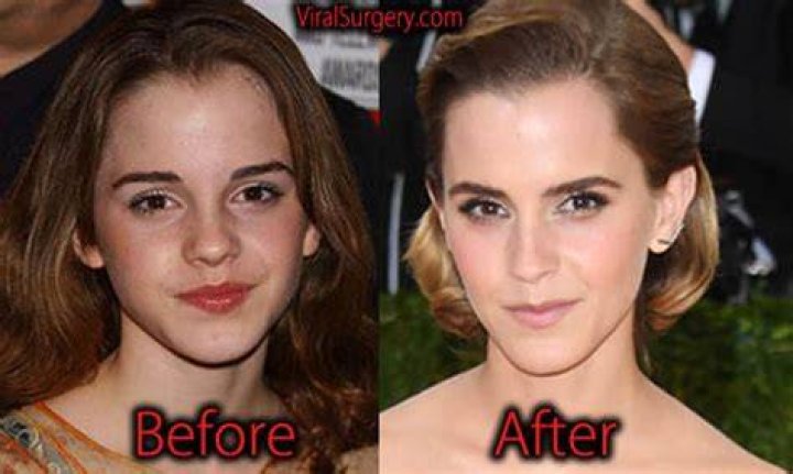 Emma Watson Nose Job Plastic Surgery Before and After
