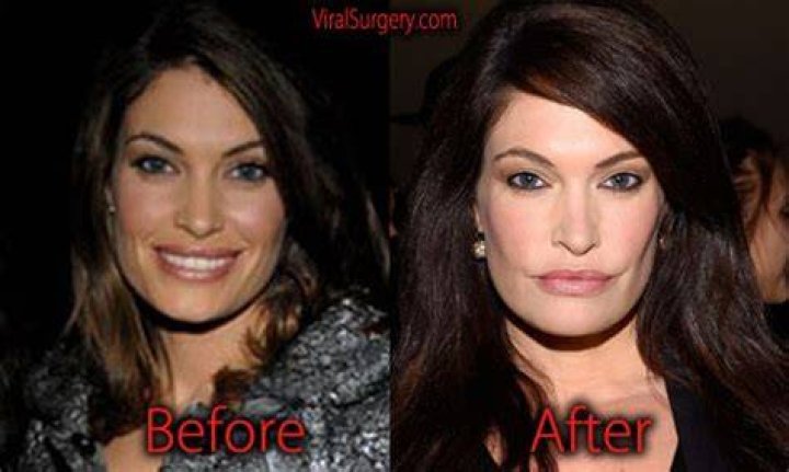 Kimberly Guilfoyle Plastic Surgery: Facelift, Botox, and the Quest for Timeless Beauty