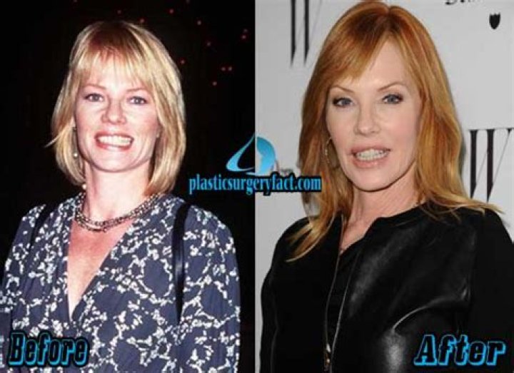 Marg Helgenberger Plastic Surgery: Has She Had Plastic Surgery?