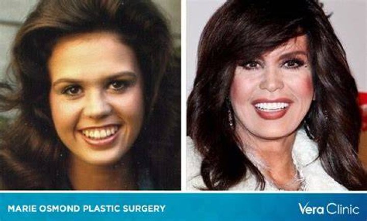 Marie Osmond Plastic Surgery: Adopting Artificial Enhancers or Glowing Naturally!