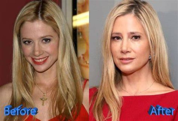 Mira Sorvino Breast Implants Plastic Surgery Before and After