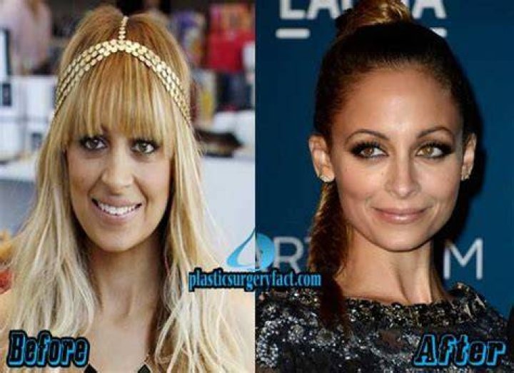 Nicole Richie Breast Augmentation Plastic Surgery Before and After