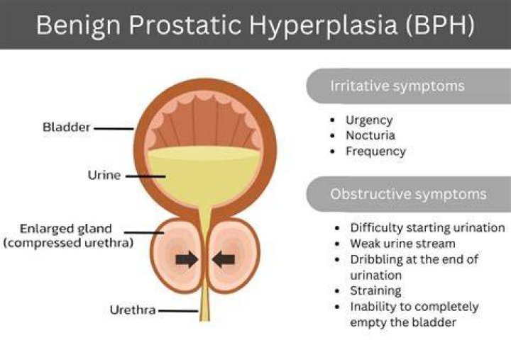 What are the symptoms of BPH and what causes it?