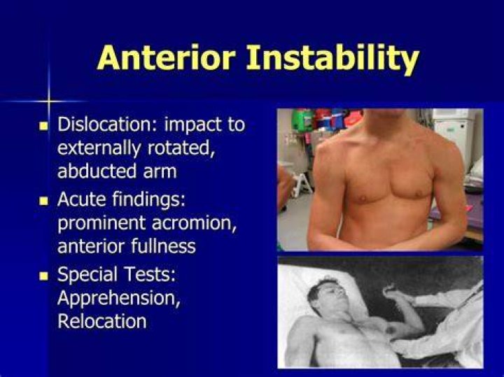 What is anterior instability?