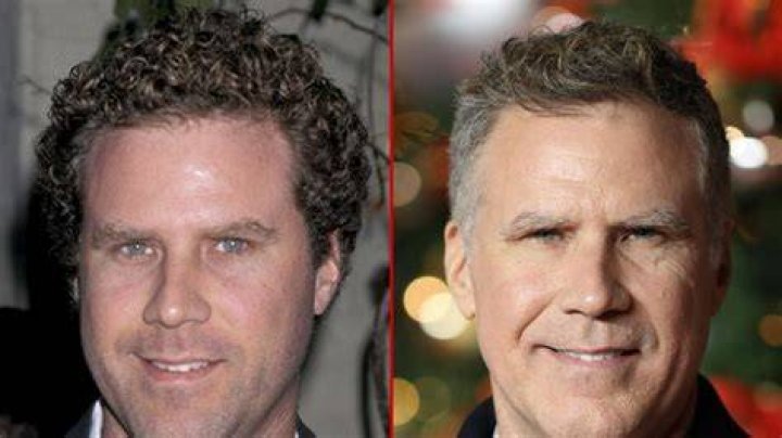 Will Ferrell Plastic Surgery: Ferrell's Admission to Undergoing Hair Loss Surgery!